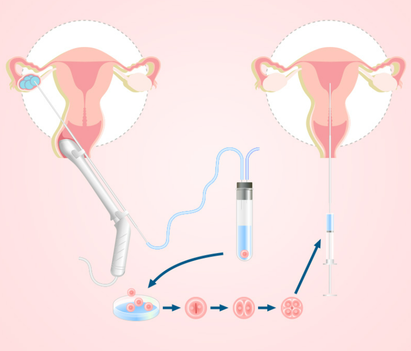 2025美国三代试管成功率解析：年龄、技术如何影响60%-85%的区间波动?