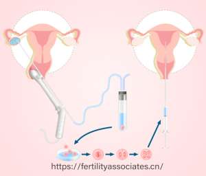 美国试管婴儿费用对比：普通IVF与